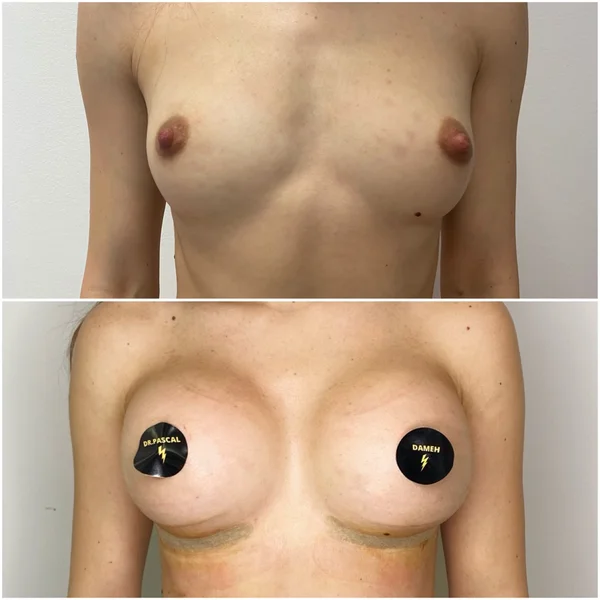 Augmentare Mamară - Implant - Rezultat 8