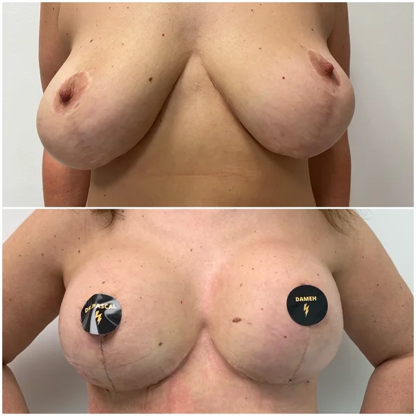 Mastopexie cu Implant - Rezultat 6