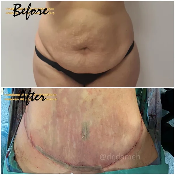Abdominoplastie - Rezultat 3