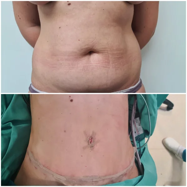 Abdominoplastie - Rezultat 2