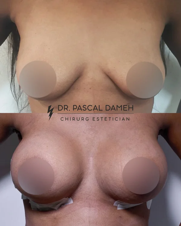 Augmentare Mamară - Implant - Rezultat 2