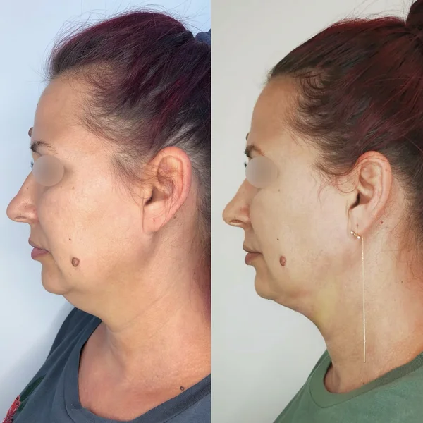 Chirurgie Facială - Rezultat 1