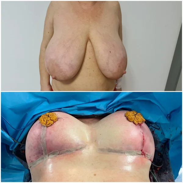 Mastopexie / Reducție Mamară - Rezultat 1
