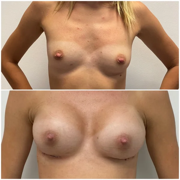Augmentare Mamară - Implant - Rezultat 7